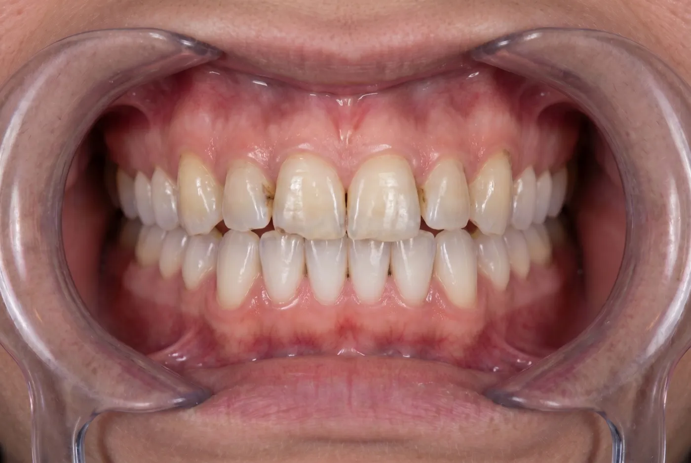Dientes desgastados y disparejos antes de las carillas de porcelana