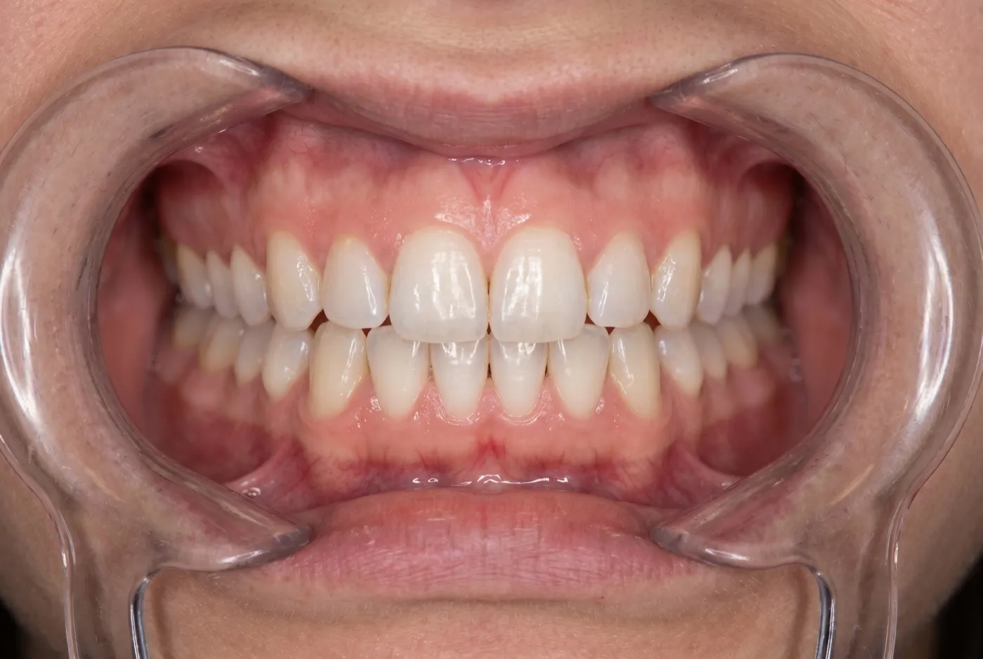 Espacio entre los dientes cerrado después del tratamiento