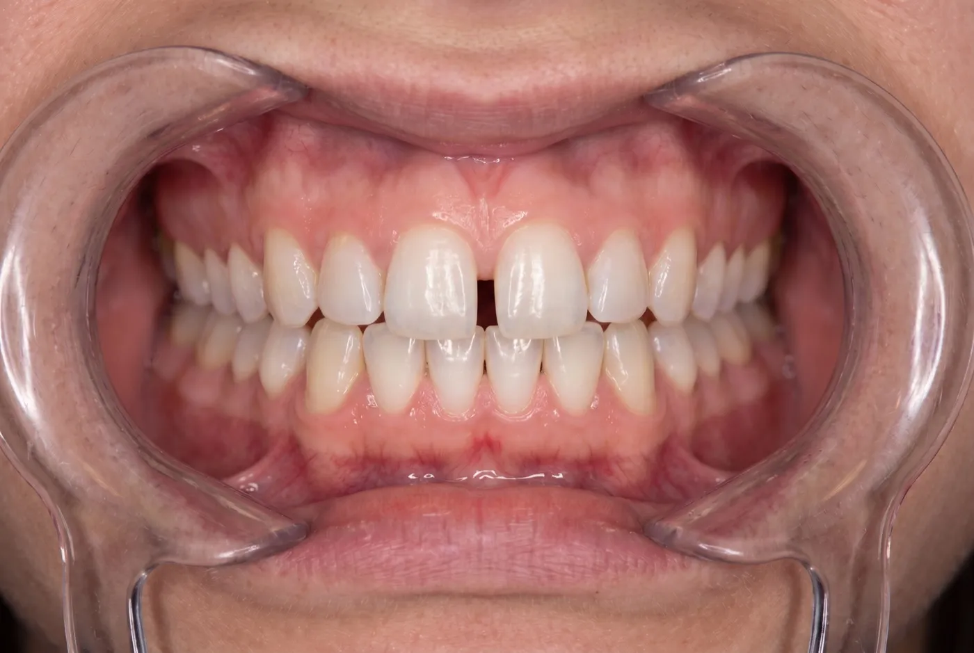 Espacio entre los dientes frontales antes del tratamiento