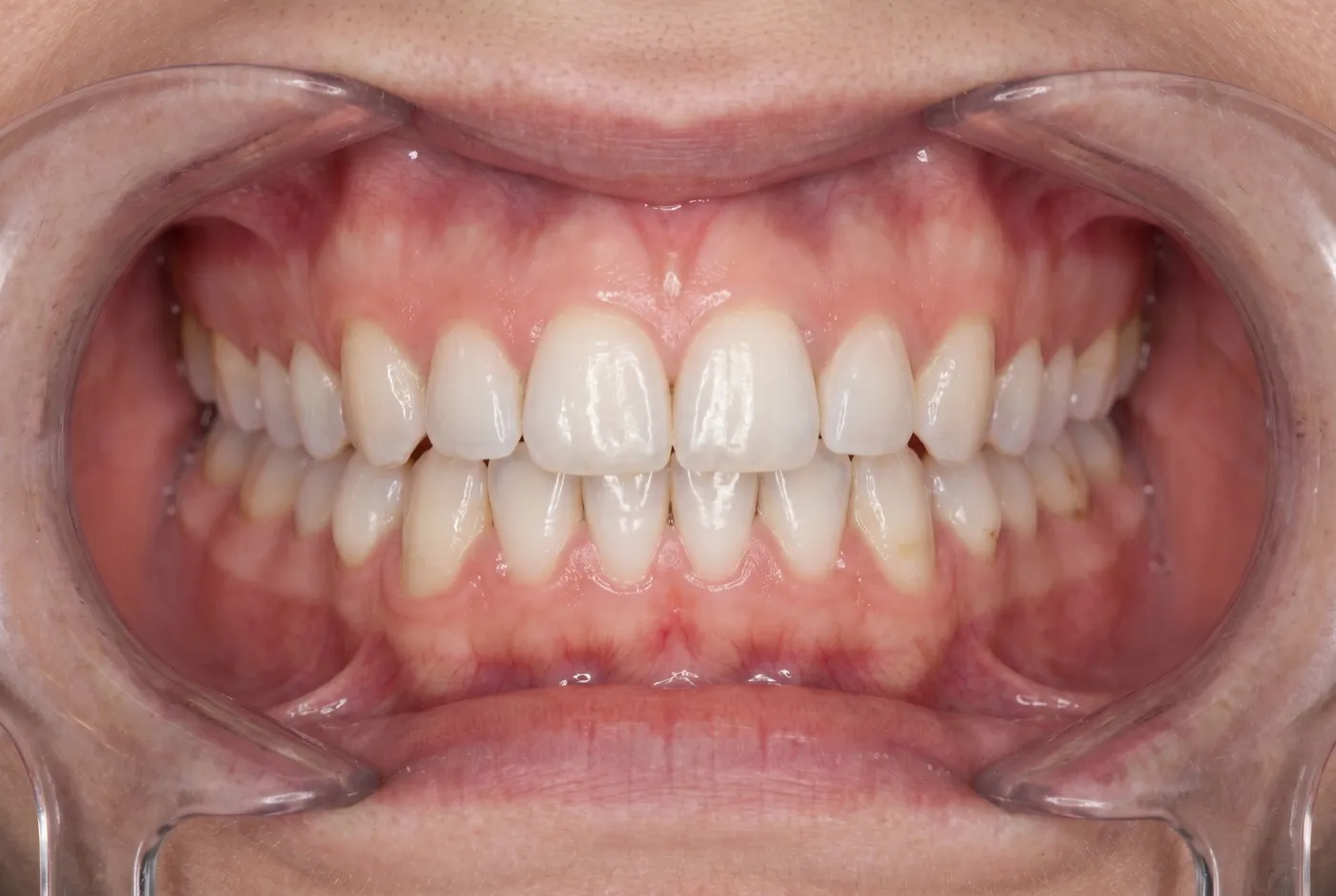 Arcada completa después de colocar el implante dental