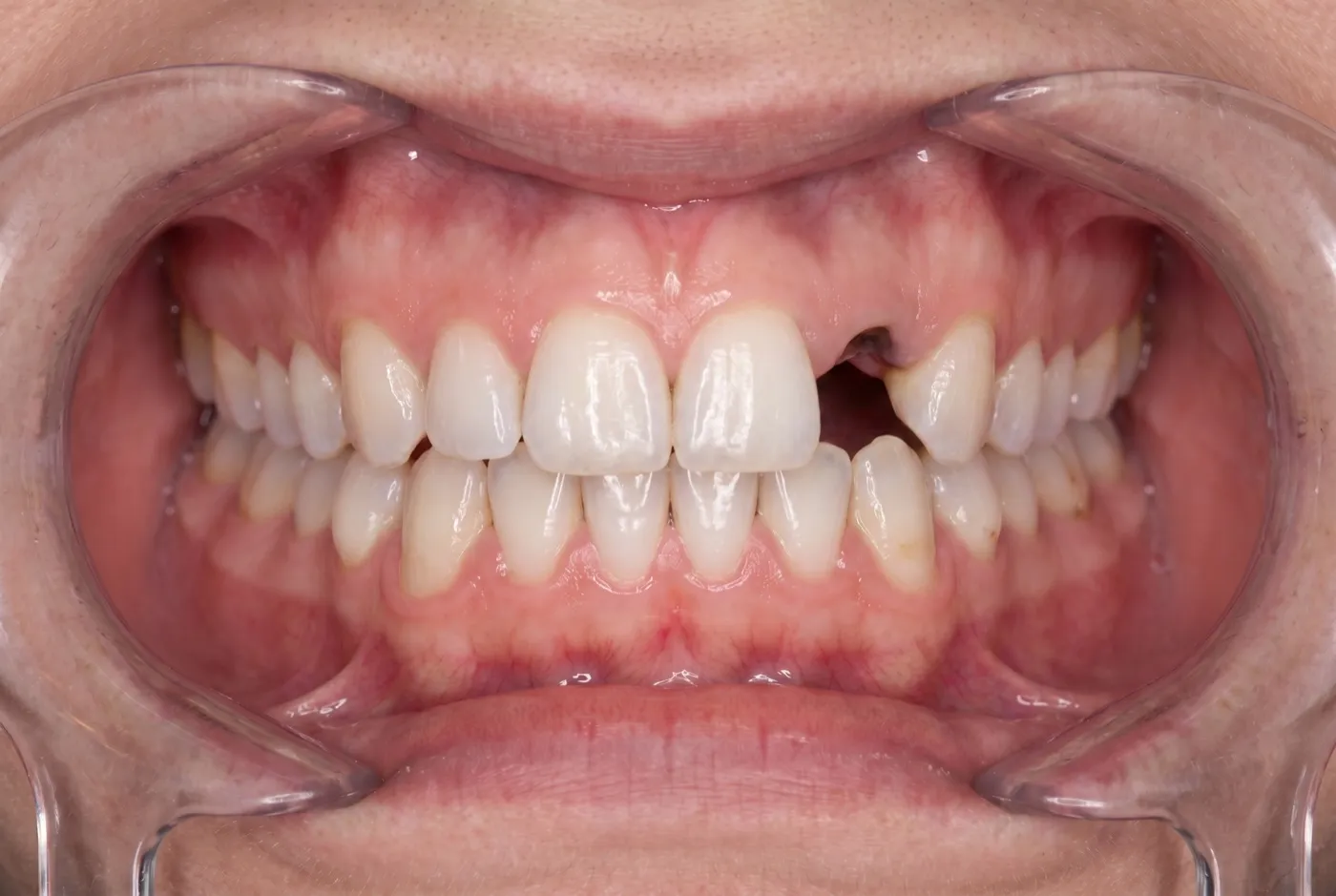 Espacio por un diente faltante antes del implante dental