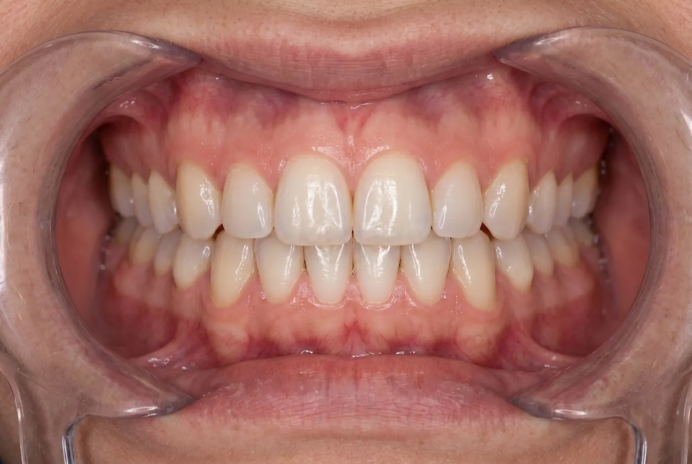 Dientes alineados después del tratamiento de ortodoncia