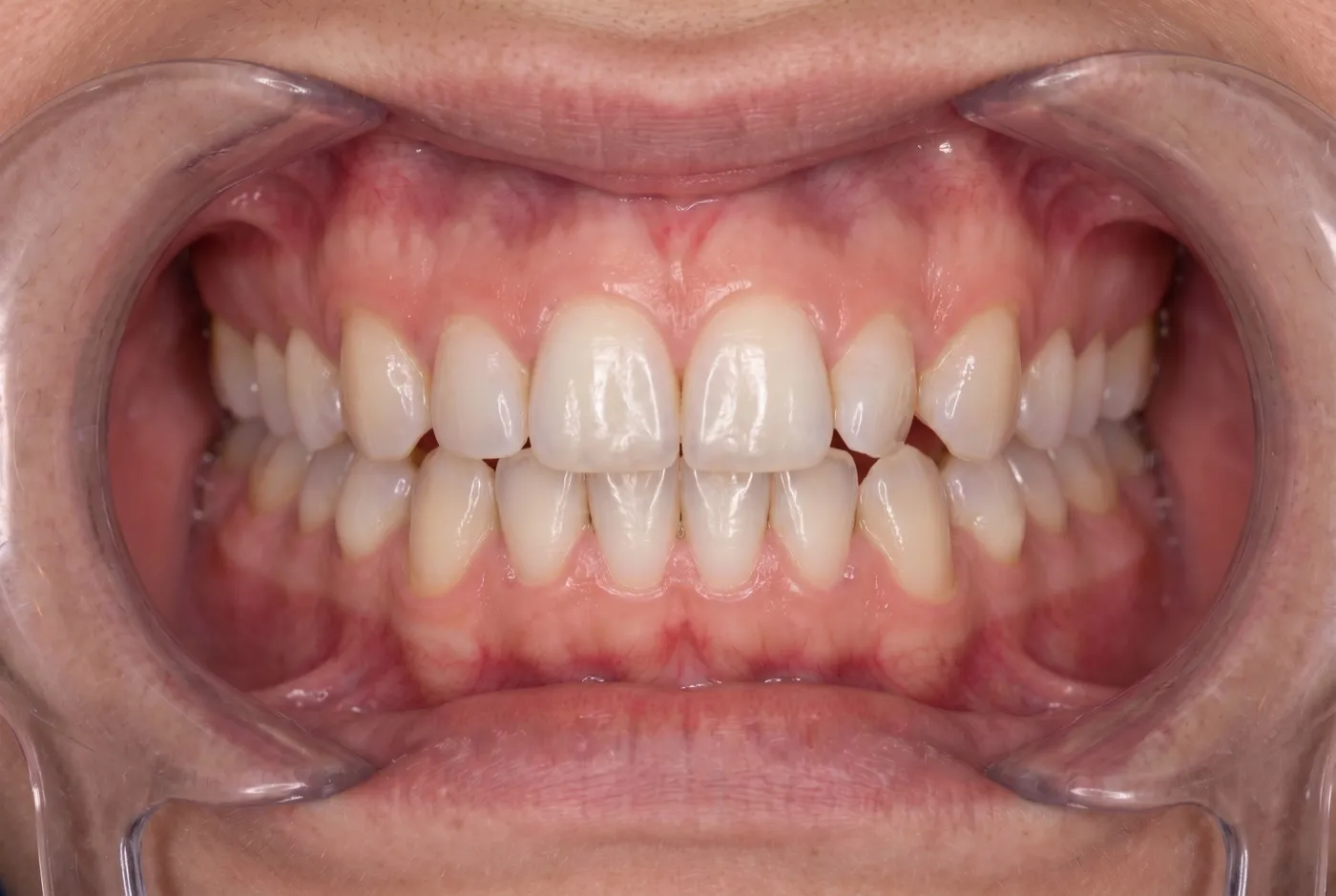 Dientes apiñados y desalineados antes del tratamiento de ortodoncia