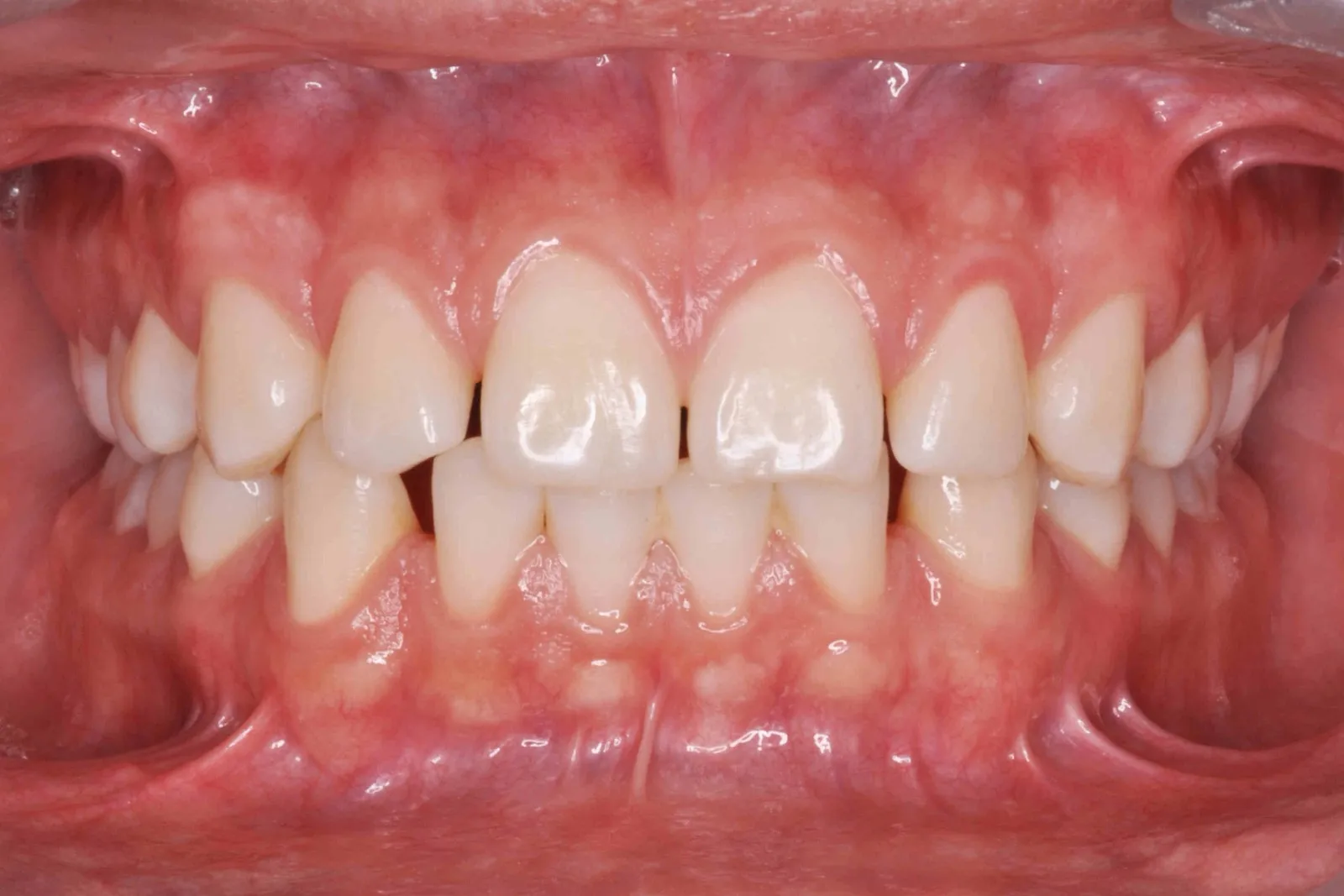 Dientes apiñados y rotados de un paciente antes de la ortodoncia en Dentisania