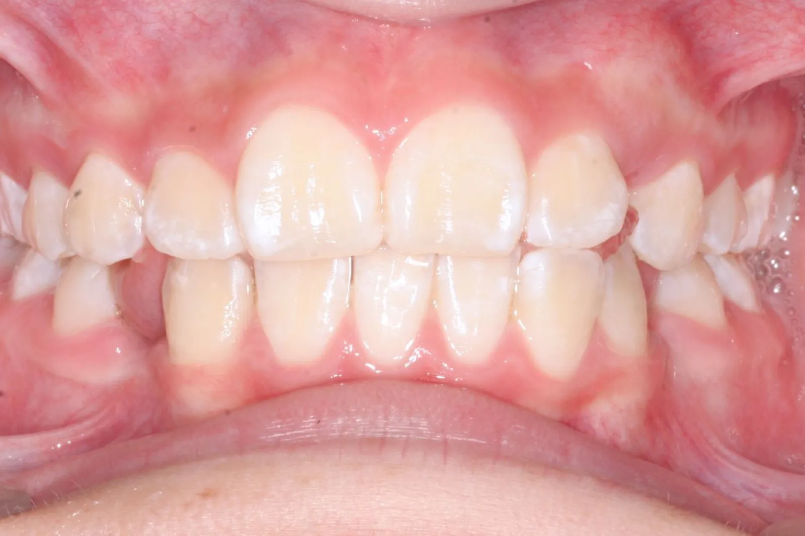 Dientes con apiñamiento antes del tratamiento de ortodoncia en Dentisania