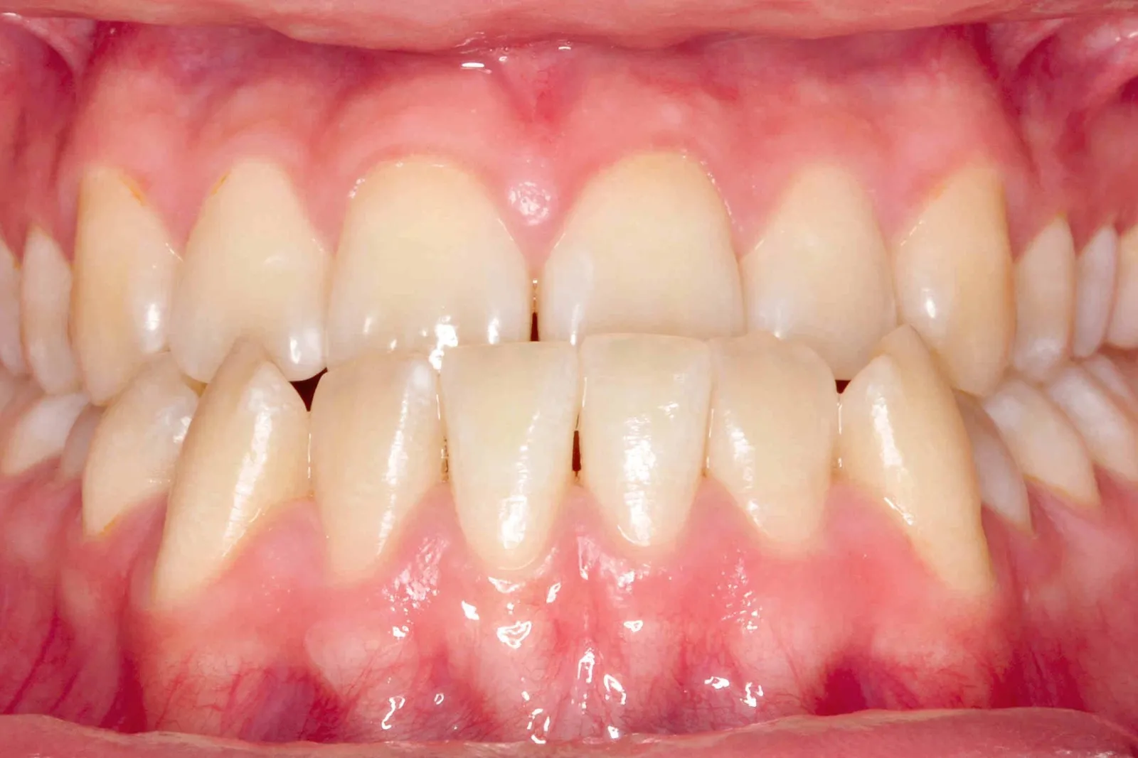 Mordida cruzada anterior antes del tratamiento orto-quirúrgico en Dentisania