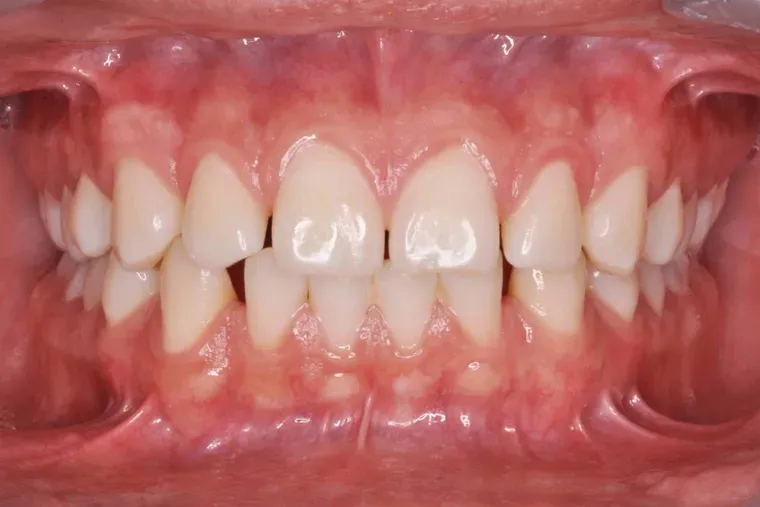 Dientes apiñados y rotados antes de la ortodoncia en Dentisania