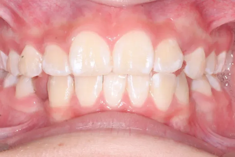 Dientes con apiñamiento antes del tratamiento de ortodoncia en Dentisania