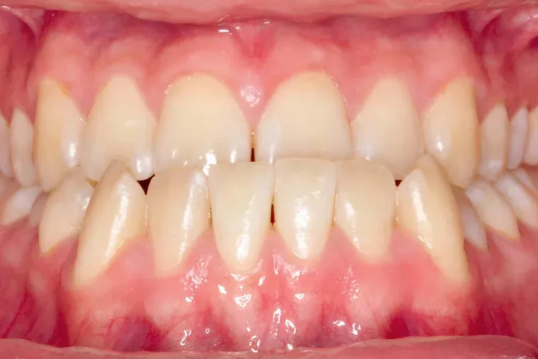 Mordida cruzada anterior antes del tratamiento orto-quirúrgico en Dentisania